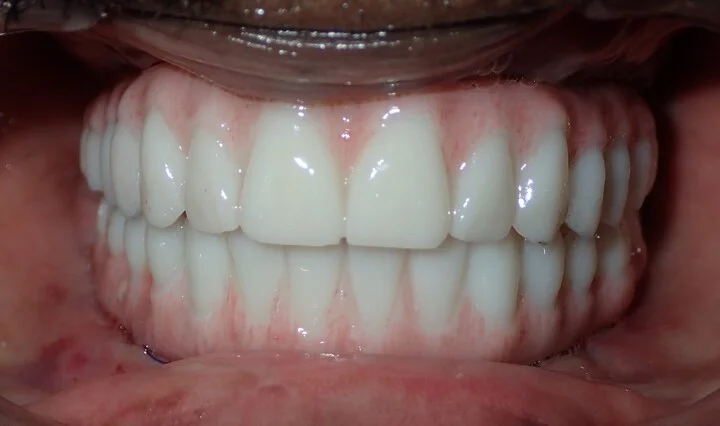 The same patient with their new fixed All-on-4 smile