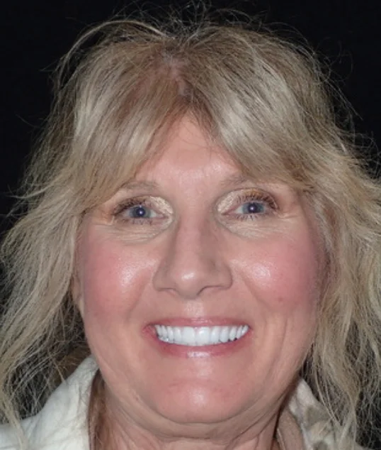 The same patient with their new fixed All-on-4 smile