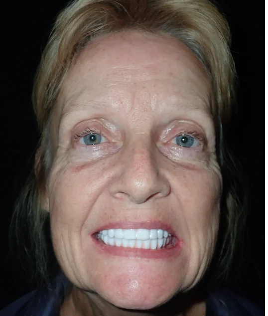 The same patient with their new fixed All-on-4 smile