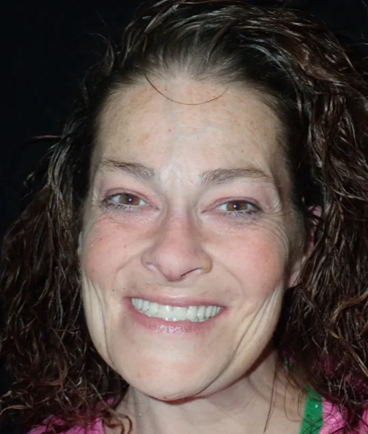 The same patient with their new fixed All-on-4 smile