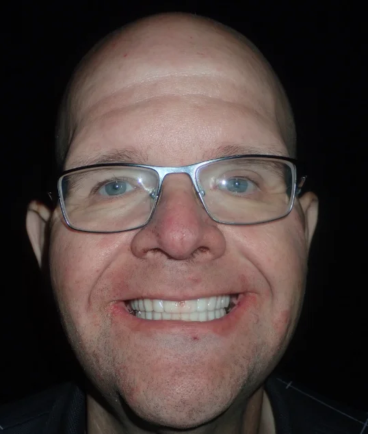 The same patient with their new fixed All-on-4 smile