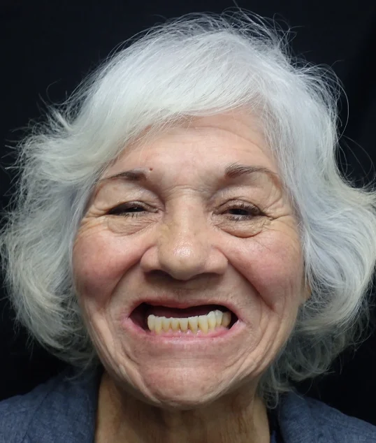 The same patient with their new fixed All-on-4 smile