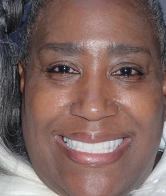 The same patient with their new fixed All-on-4 smile
