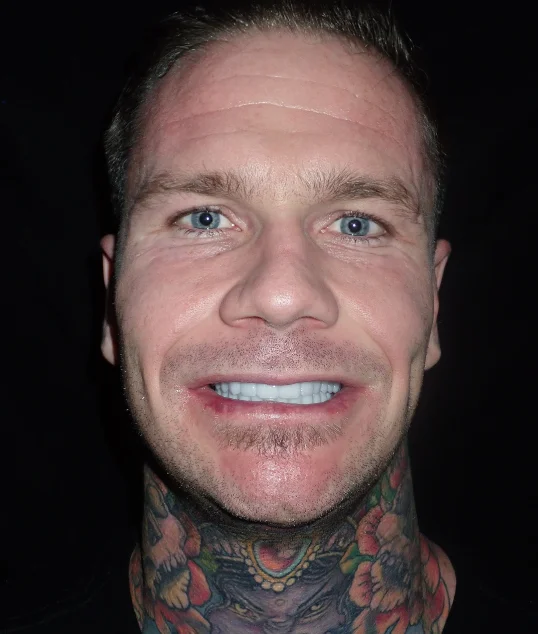 The same patient with their new fixed All-on-4 smile