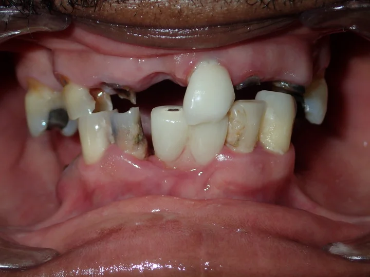 Patient before All-on-4 treatment