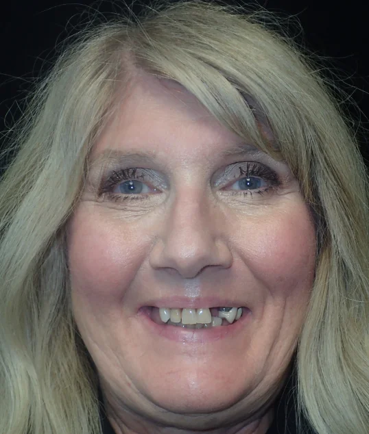 Patient before All-on-4 treatment