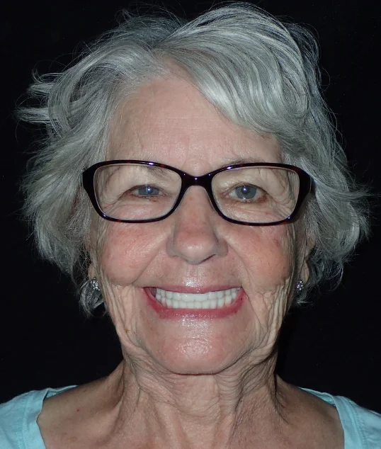 The same patient with their new fixed All-on-4 smile