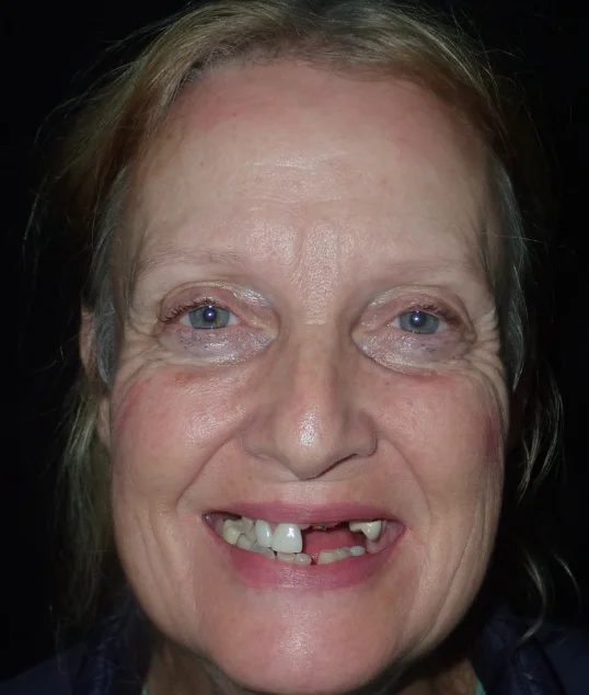 Patient before All-on-4 treatment