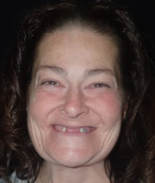 Patient before All-on-4 treatment