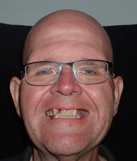 Patient before All-on-4 treatment
