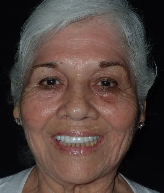 Patient before All-on-4 treatment